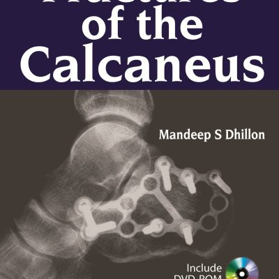 Fractures of the Calcaneus