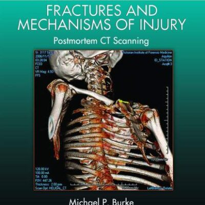 Forensic Pathology Of Fractures And Mechanisms Of Injury Postmortem Ct Scanning (Pb 2021)
