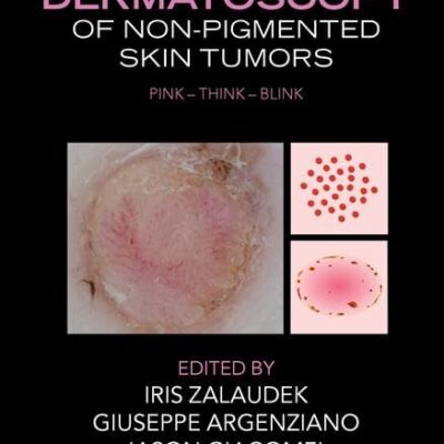 DERMATOSOCOPY OF NON PIGMENTED SKIN TUMORS (HB 2016)